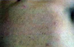 Laser Acne Treatment After