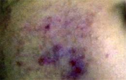 Laser Acne Treatment Before