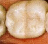 white fillings in Catford - white Fillings After
