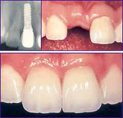 Dental implants