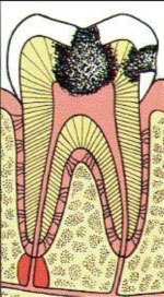 Root Canal