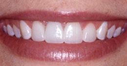 Veneers Catford - after photo of teeth after veneers