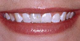 Veneers Catford - Before photo of teeth before veneers