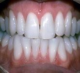 Whitening After Teeth Whitening in Catford After