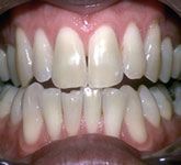 Whitening Before Teeth Whitening in Catford Before
