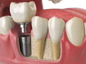 Dental Implants london Catford