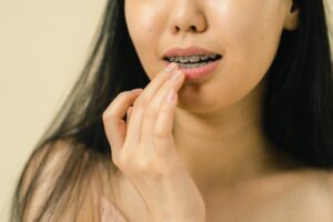 Orthodontist - traditional braces