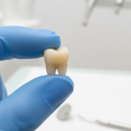 How Long Does a Dental Crown Take? A Complete Guide to Your Dental Crown Journey